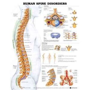Human Spine Disorders Anatomy 3D Raised Chart/Poster:  